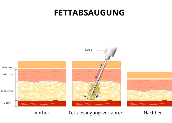 Grafik einer Fettabsaugung.