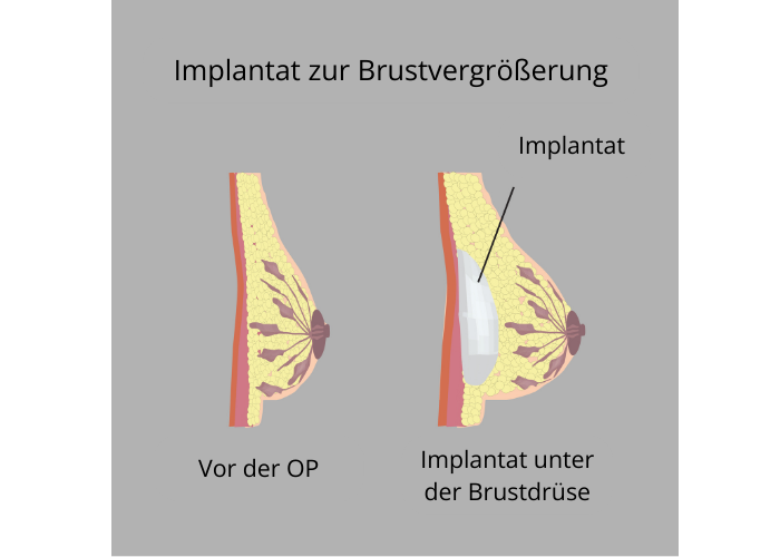 Grafik zur Brustvergrößerung.