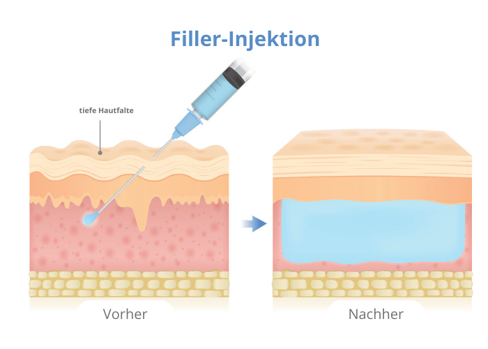 Grafische Darstellung einer Filler-Injektion.