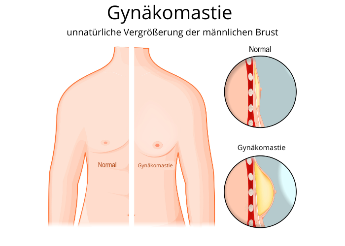 Grafische Darstellung Gynäkomastie.
