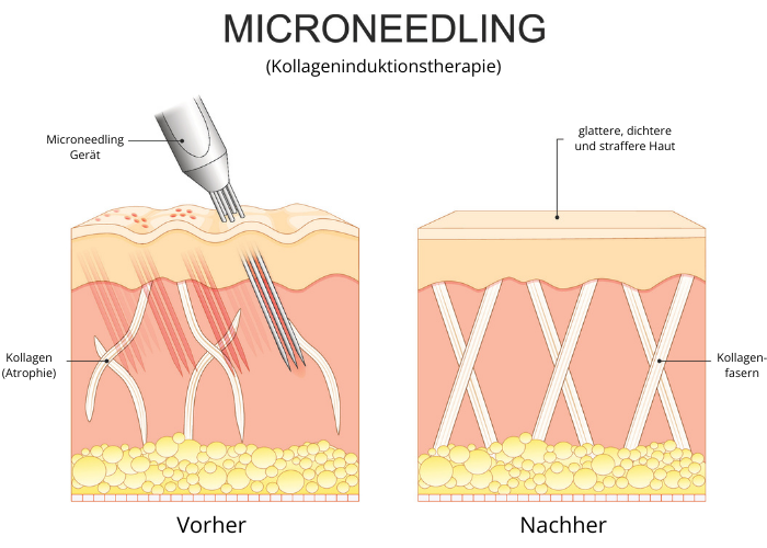 Grafische Darstellung einer Microneedling-Behandlung.